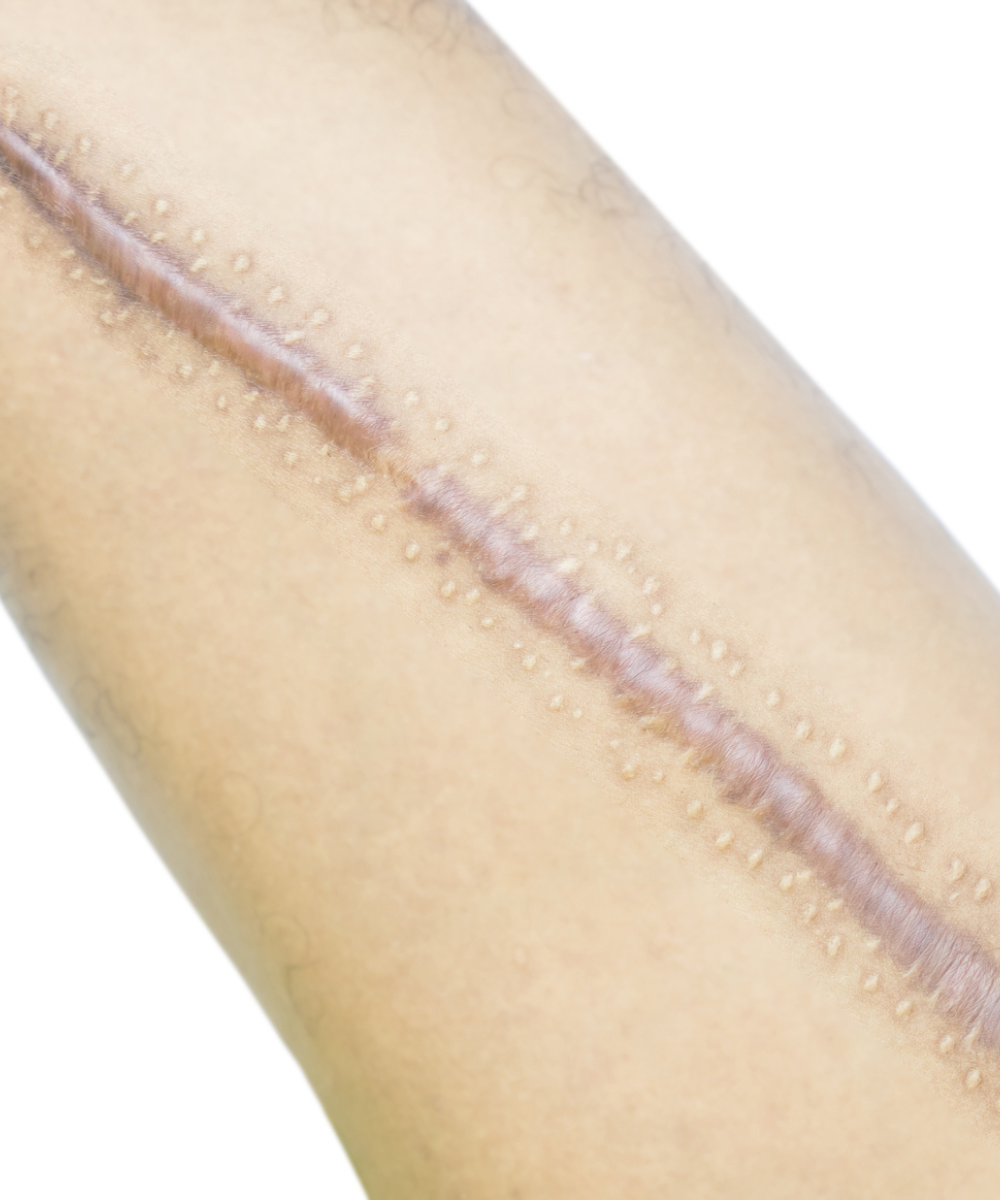 Keloid/scar Meta Dermatology