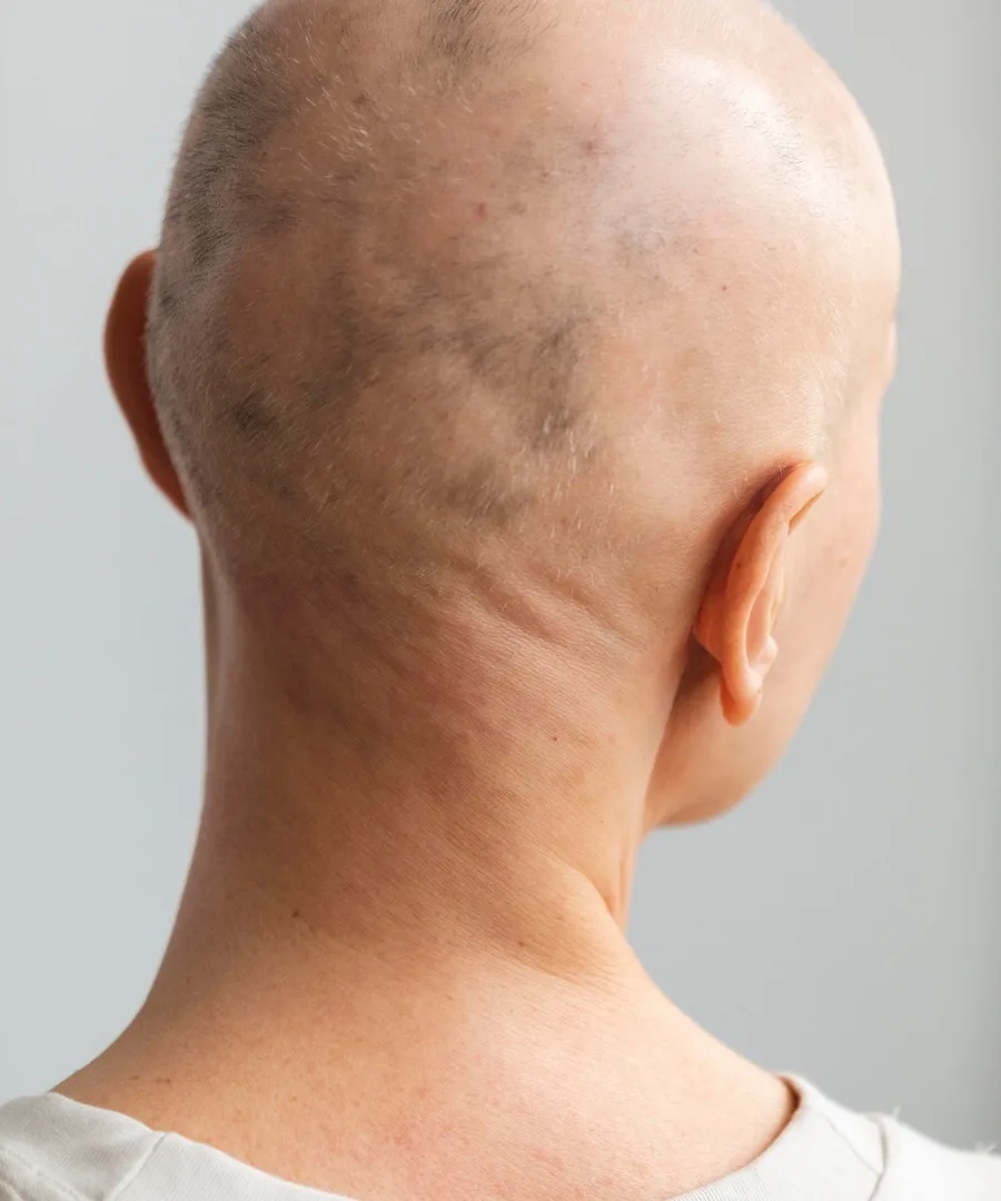 Alopecia areata hair loss balding autoimmune treatment near Moorestown, NJ by dermatologist skin specialist doctor