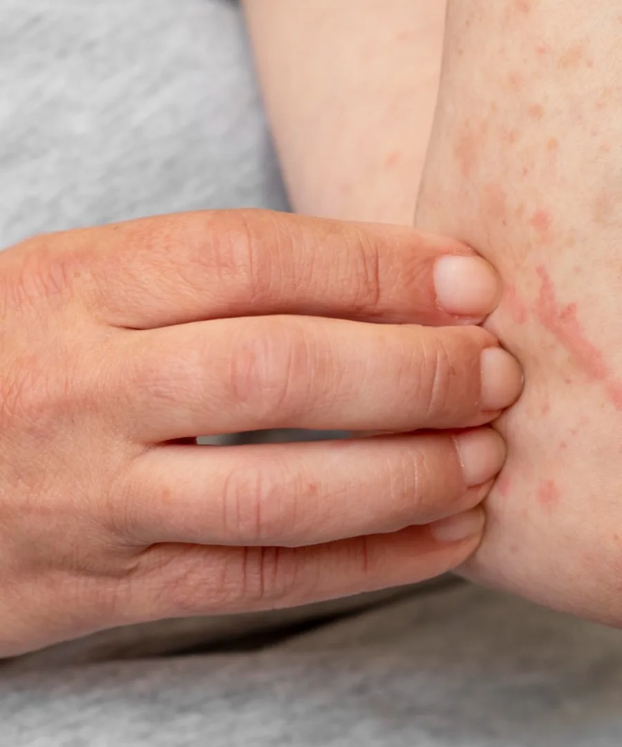 contact dermatitis skin allergy poison ivy itchy skin treatment near Moorestown NJ by dermatologist skin care specialist doctor