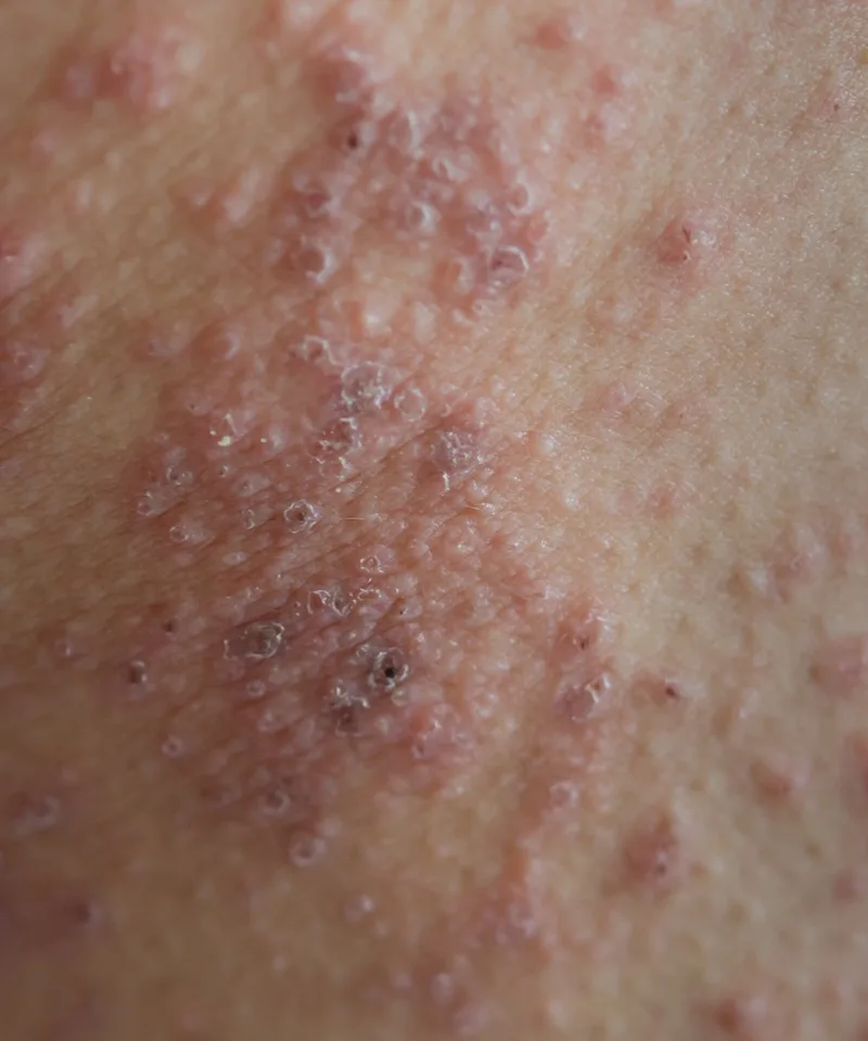 Eczema, atopic dermatitis, dry skin, itchy skin treatment near Moorestown, NJ by dermatologist skin specialist doctor