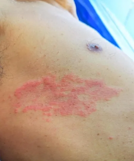 shingles herpes zoster painful rash treatment by dermatology skin specialist doctor near moorestown, nj