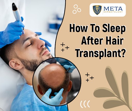 how to sleep after hair transplant