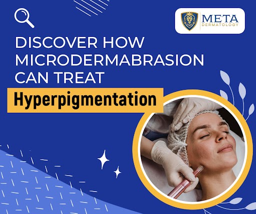 Does Microdermabrasion Help with Hyperpigmentation