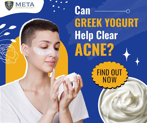 is greek yogurt good for acne