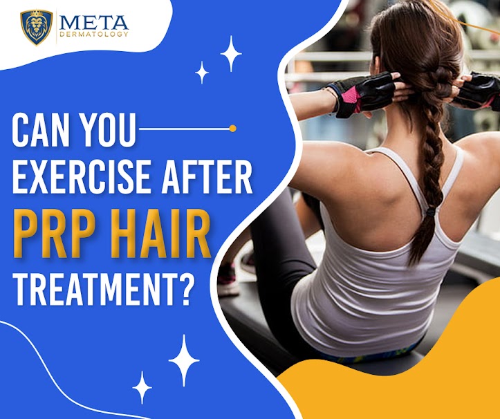 Can you exercise after PRP hair treatment