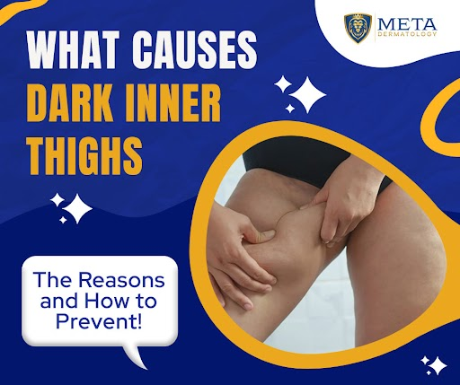 what causes dark inner thighs