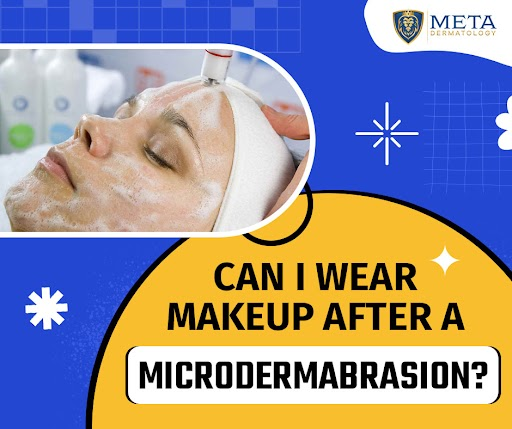 Can I wear makeup after a microdermabrasion