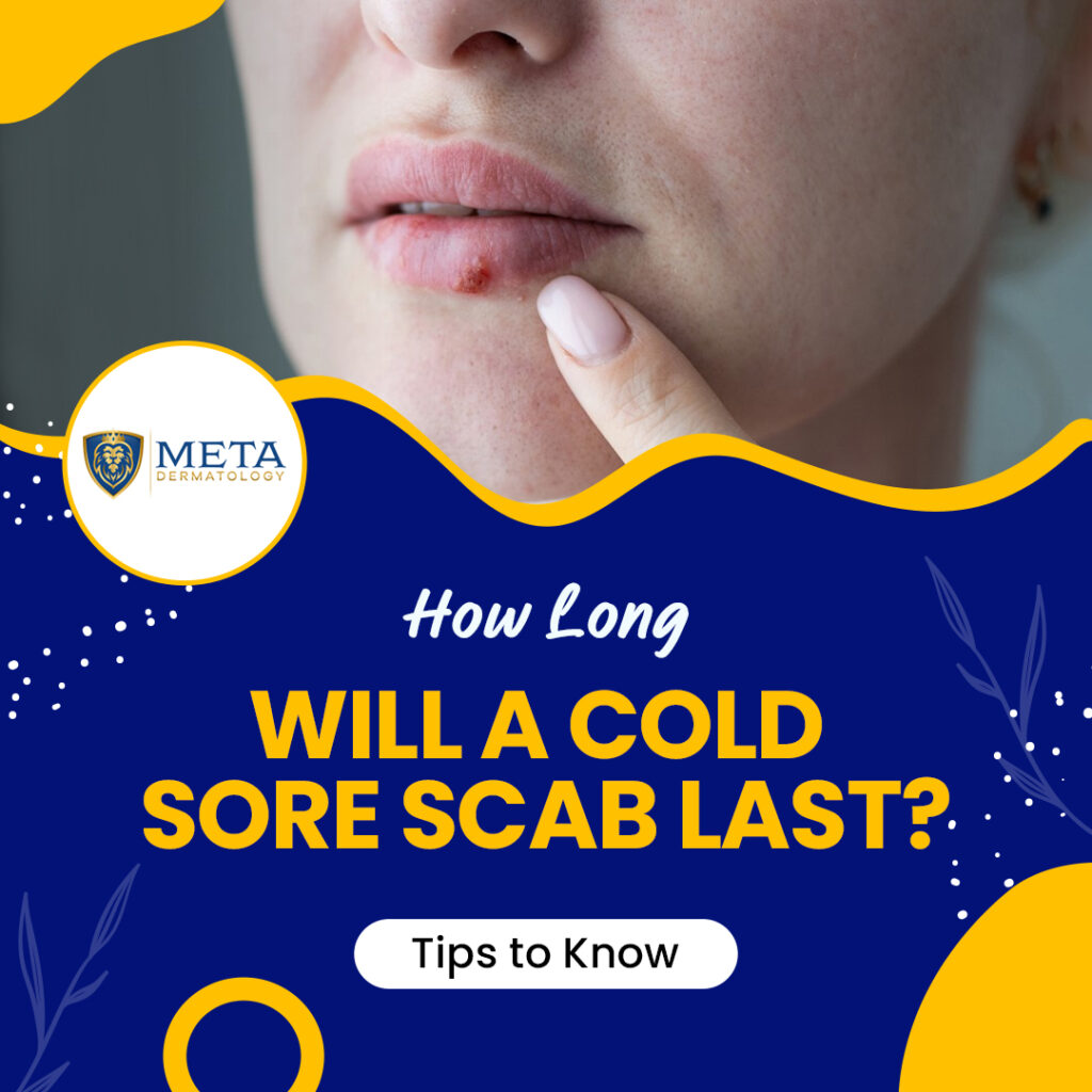 how long will a cold sore scab last