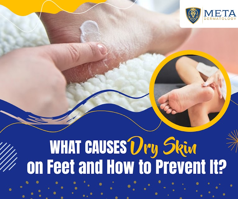 what causes dry skin on feet