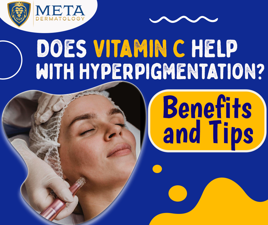 does vitamin c help with hyperpigmentation