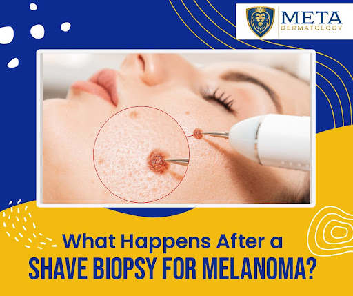 Can a Shave Biopsy Detect Melanoma