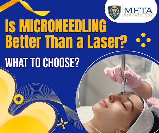 Is Microneedling Better Than Laser