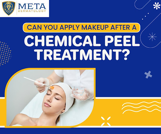 Can I Apply Makeup After Chemical Peel Treatment?